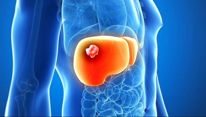 腰痛多年，竟是因感染肝炎！肿瘤已桔子大，通过这种方法消融肿瘤