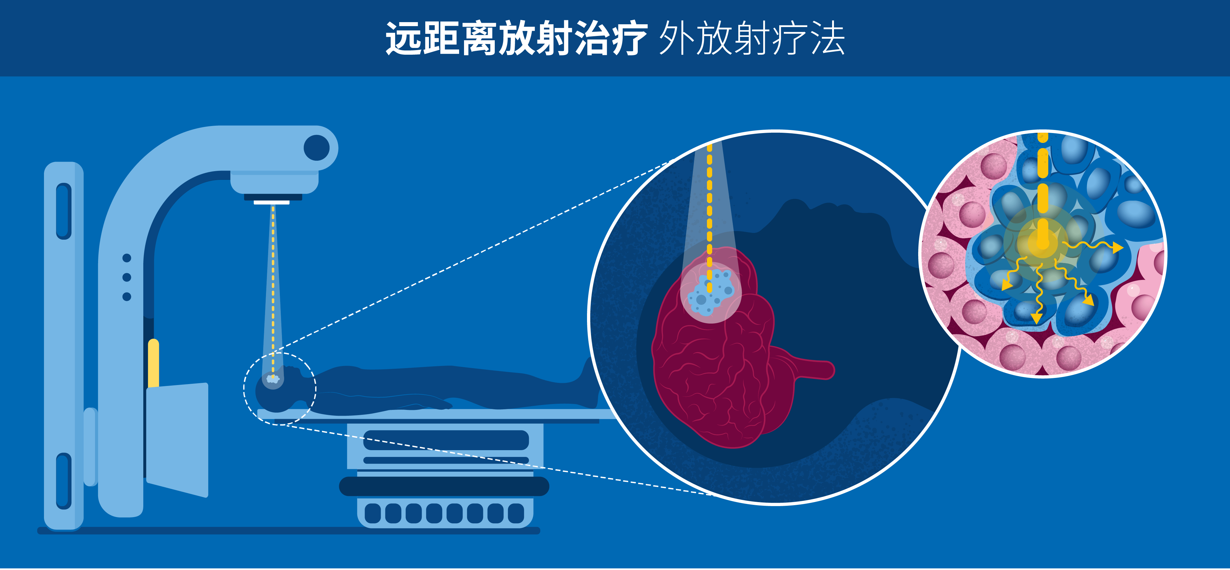 放疗科专家揭秘，约40%癌症可通过放疗根